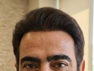 تصویر بعد از کاشت مو